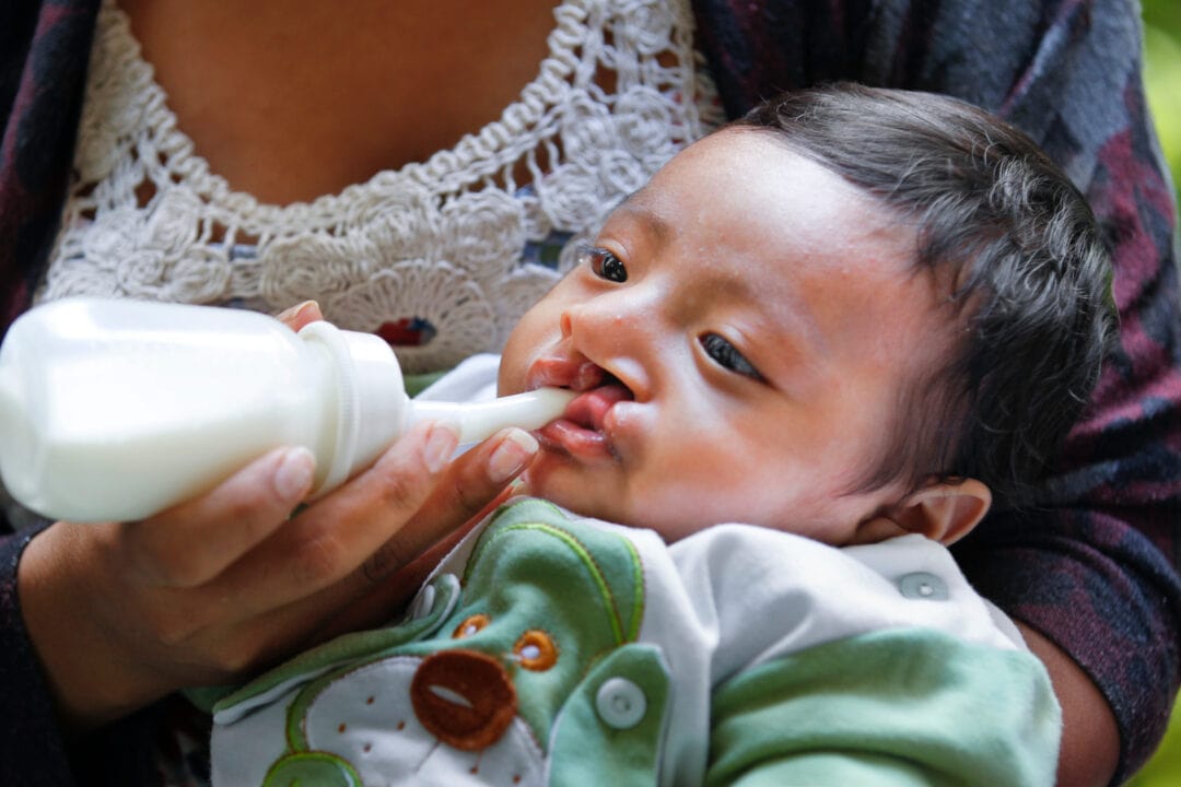 Newborn with cleft been fed with special bottle. Photo: Marc Ascher