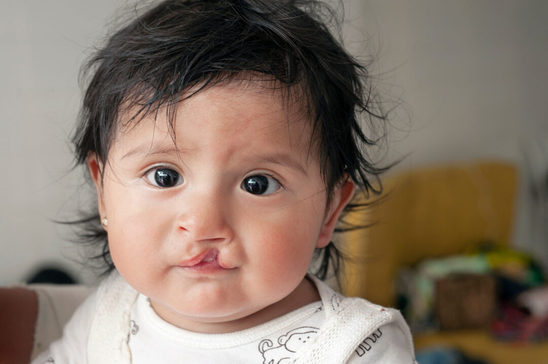 Eight-months-old Heydi, before cleft surgery. Photo: Margherita Mirabella