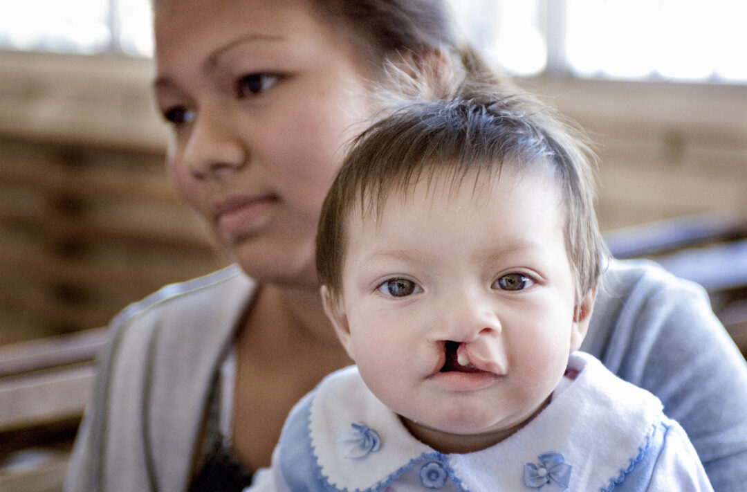 Britany at 10 months old with her mother, Cinthia, before surgery at the Operation Smile Honduras care centre. Photo: Angela Weedon