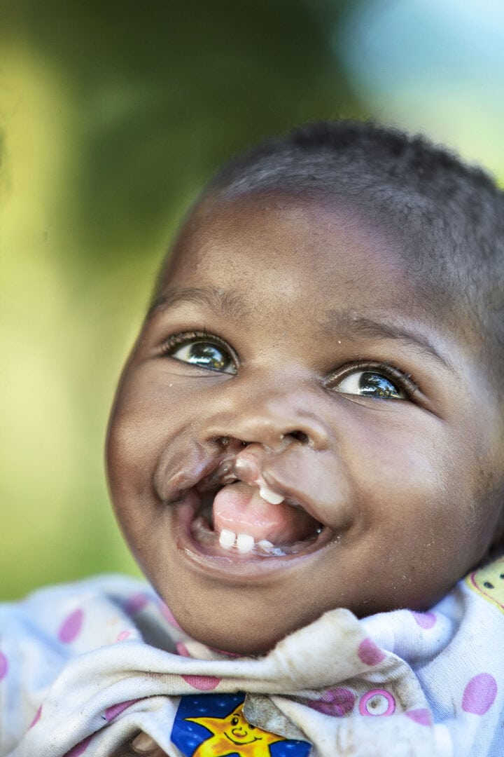 Sonia before her cleft surgery