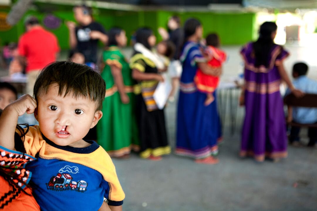 Baby boy with cleft lip and cleft palate looks at camera