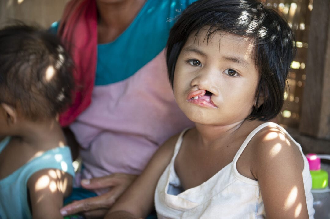Loraine born with cleft lip in the Philippines