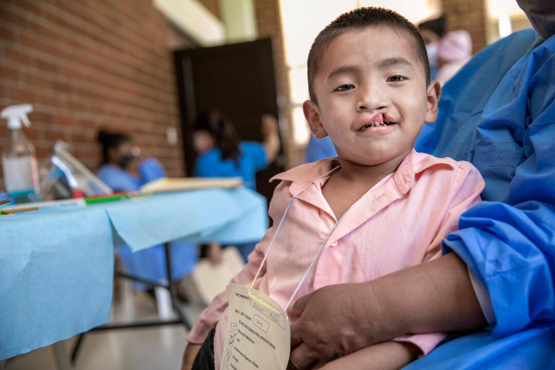 Six-year-old Erwi before cleft surgery.