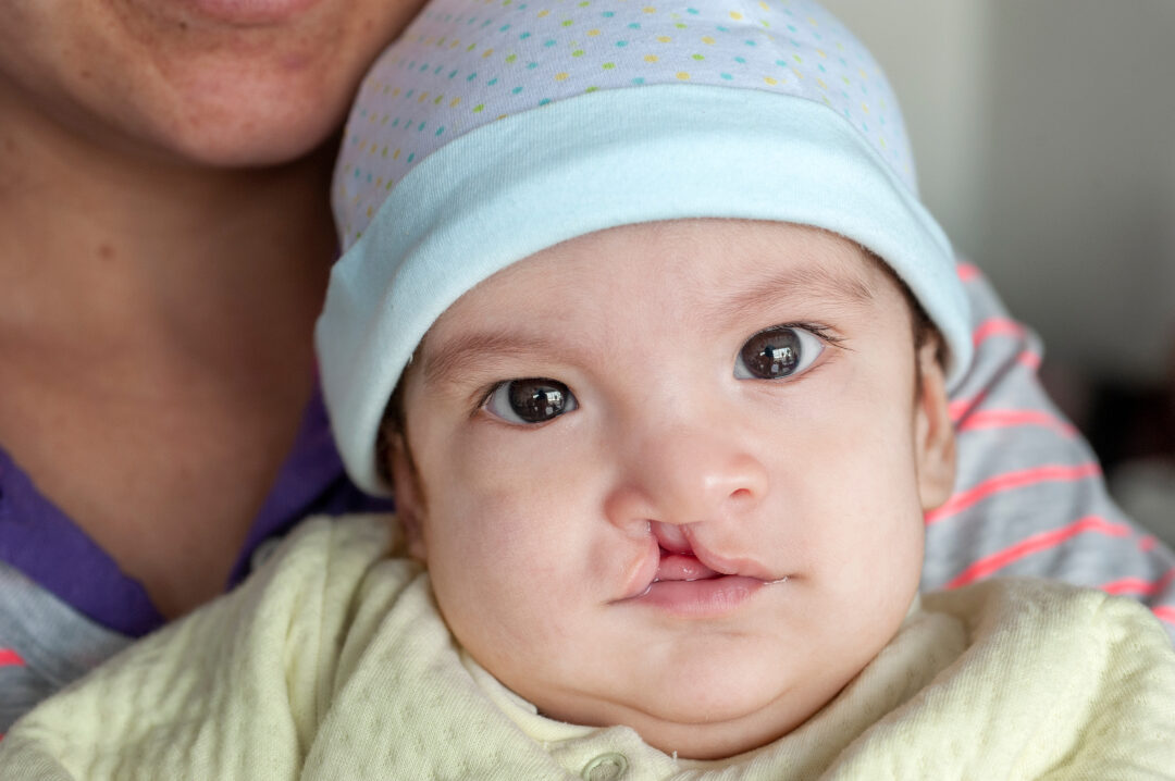Four-month-old Arian before cleft surgery.  Photo: Margherita Mirabella