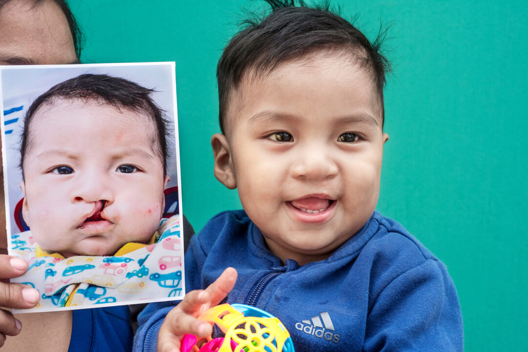 One-year-old Eduardo after cleft surgery. Photo:  Margherita Mirabella