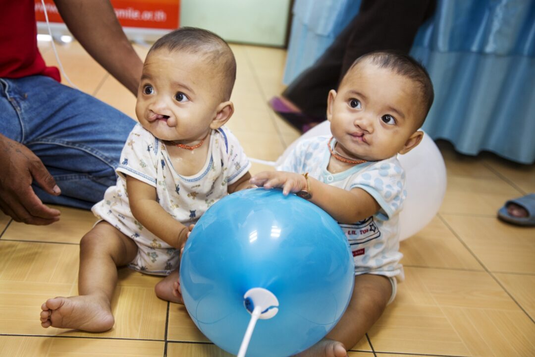 twin boys with cleft