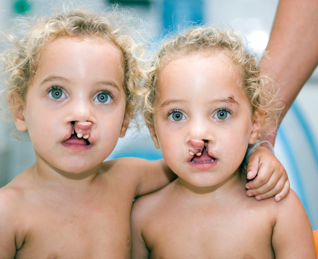 Twin sister with cleft lip