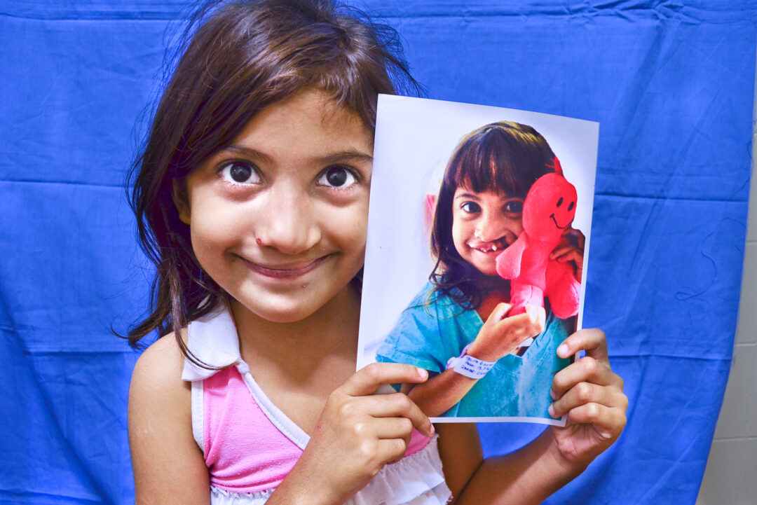 Six-year-old Talita holds a photo of herself before cleft surgery