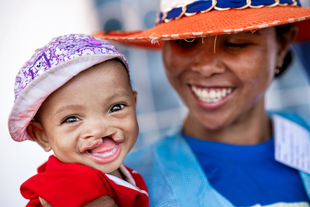 Baby with cleft smiles