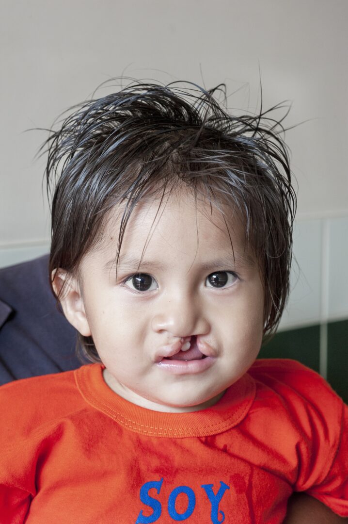 Here is 14-month-old Damian before surgery with his mom, Nora. Photo: Margherita Mirabella.