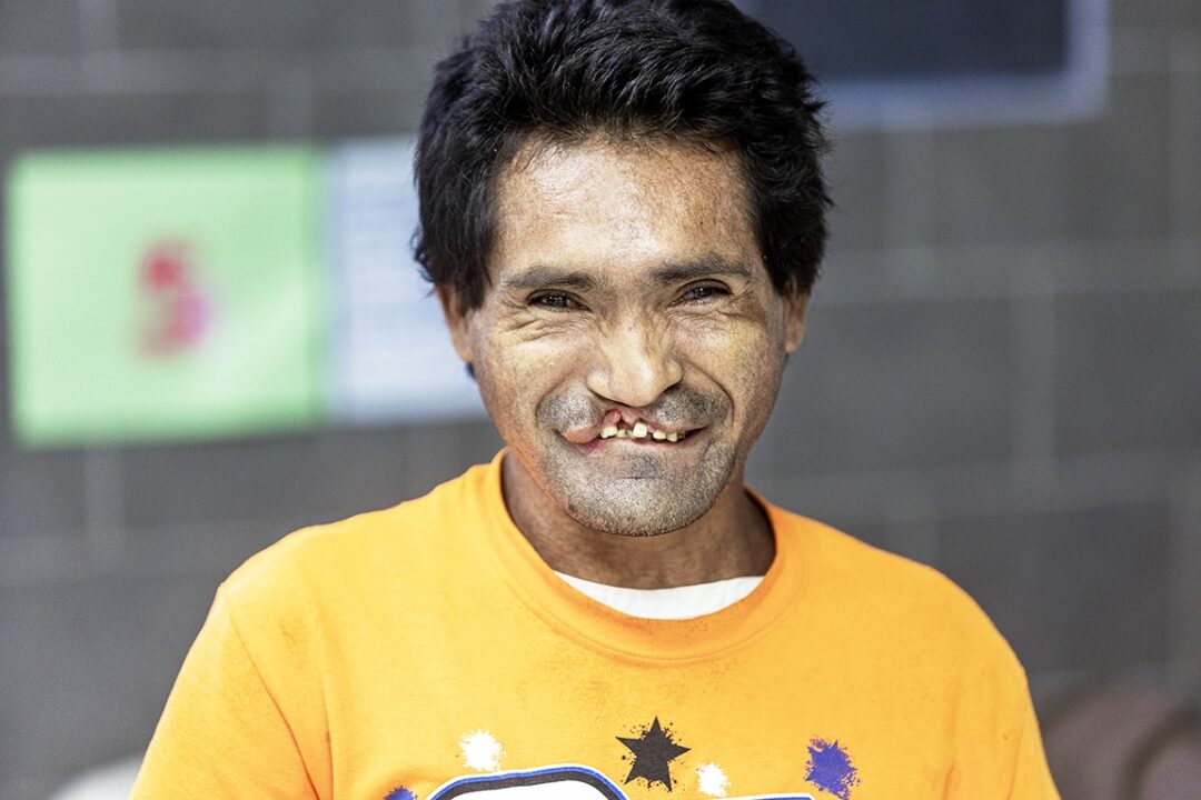 Adelmo before surgery. Photo: Carlos Rueda