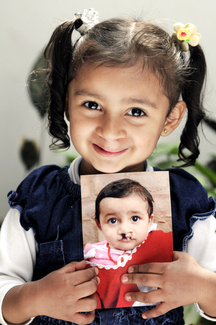 Young girl smiles at the camera, holding a picture of herself as a baby with a cleft lip.