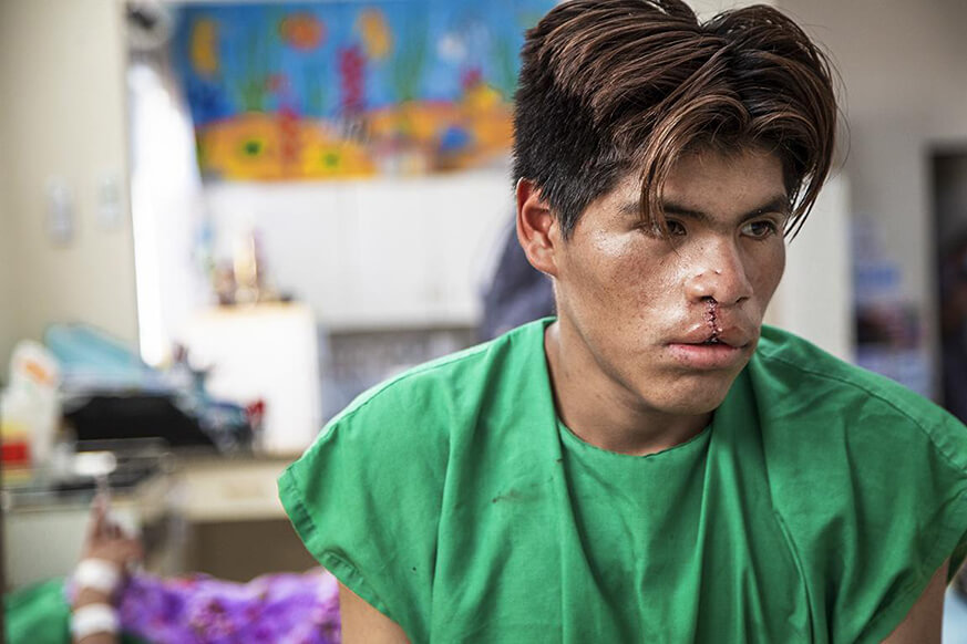 Teofilo sits, wearing green surgical scrubs, after his cleft lip surgery.