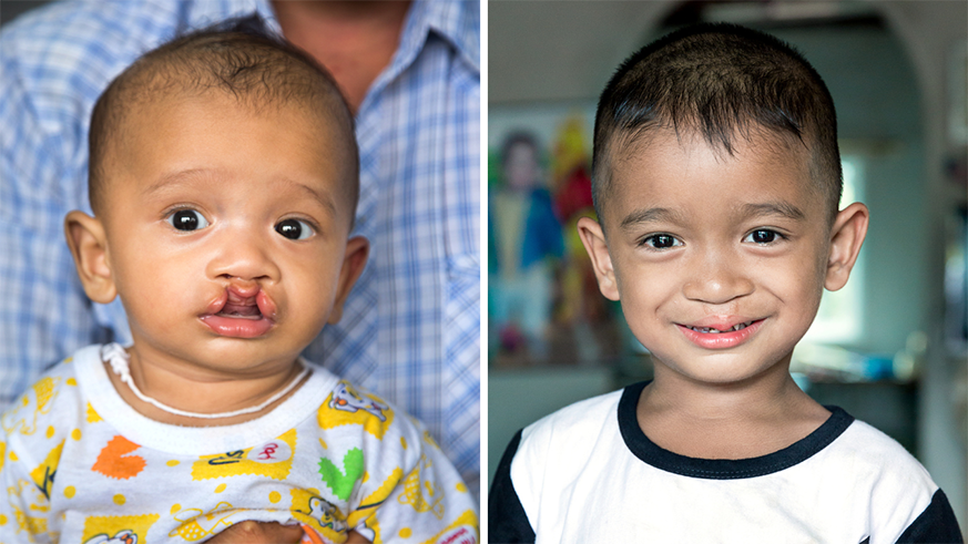 On the left is a picture of Ake as a baby. He has a cleft lip. On the right is a picture of three year old Ake after his cleft lip surgery. He is smiling at the camera.