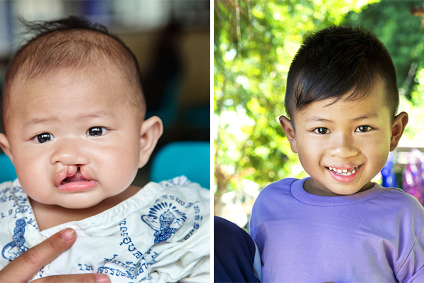On the left is a photo of Beam as a baby. He has a cleft lip. On the right is a picture of three year old Beam after his cleft lip surgery. He is wearing a purple tshirt and smiling at the camera.