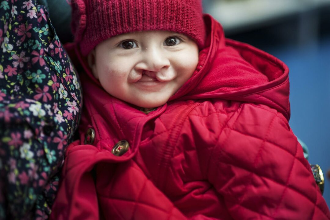 Luciana before her cleft surgery. She is wearing a red padded coat and a red knitted hat.