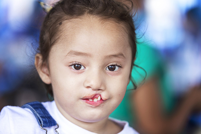 Three year old Zoe looks into the camera. She has a cleft lip.