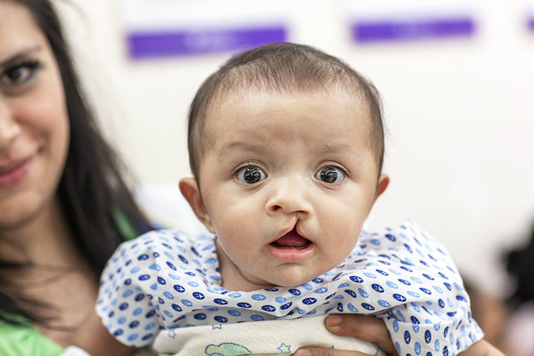 A close-up of a surprised-looking baby wearing a blue and white polka-dot outfit while being held by an adult whose partial face is visible. The baby has wide eyes and an open mouth with a cleft lip, and there are out-of-focus background elements.