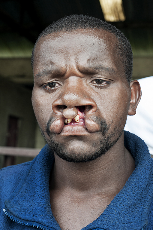 A man with a dark beard and mustache has a bilateral cleft lip. He is wearing a blue jacket and is standing outside with a neutral expression. The background appears to be an outdoor setting with some structure visible.