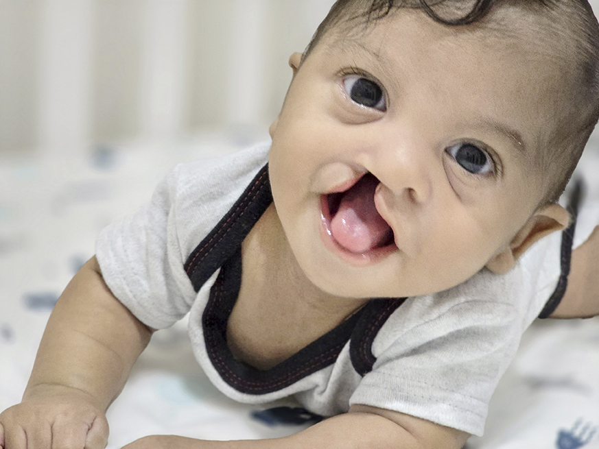 A baby with a cleft lip and palate smiles while lying on their stomach. They are wearing a light grey shirt with dark trim and have curly hair. The background is soft and blurred.