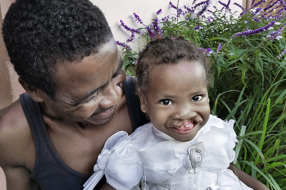 A man in a dark tank top lovingly smiles at a young child with a cleft lip, wearing a white dress. They are sitting outdoors surrounded by greenery and purple flowers.