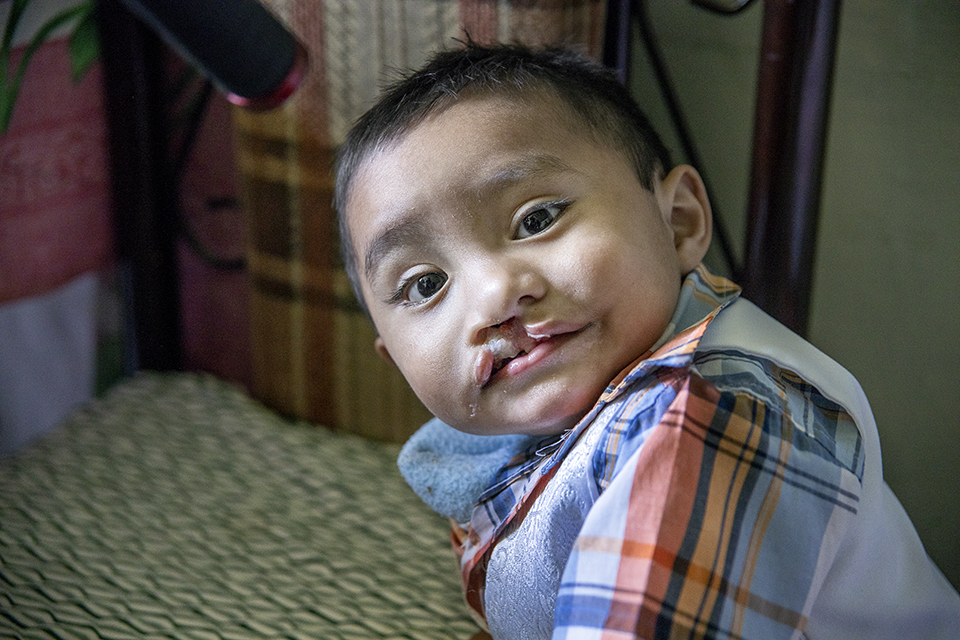 A young child with a cleft lip, wearing a plaid shirt, looks over their shoulder while sitting on a patterned seat. The child has short hair and an expressive face.