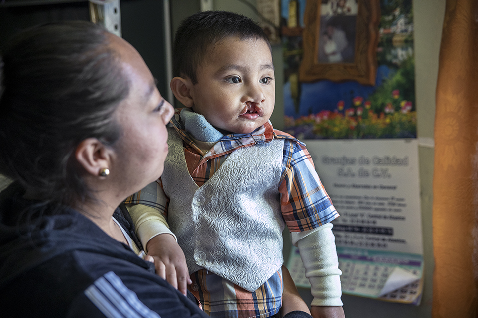 A woman holds a young boy with a cleft lip and a medical bandage on his neck. The boy wears a plaid shirt and vest, looking off to the side. They are indoors with posters on the wall behind them.