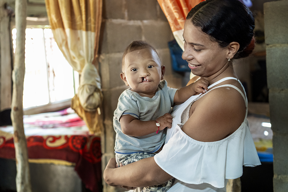 A smiling woman in a white top holds a young child with a cleft lip. They are indoors, standing near a window with orange curtains and a bed in the background.