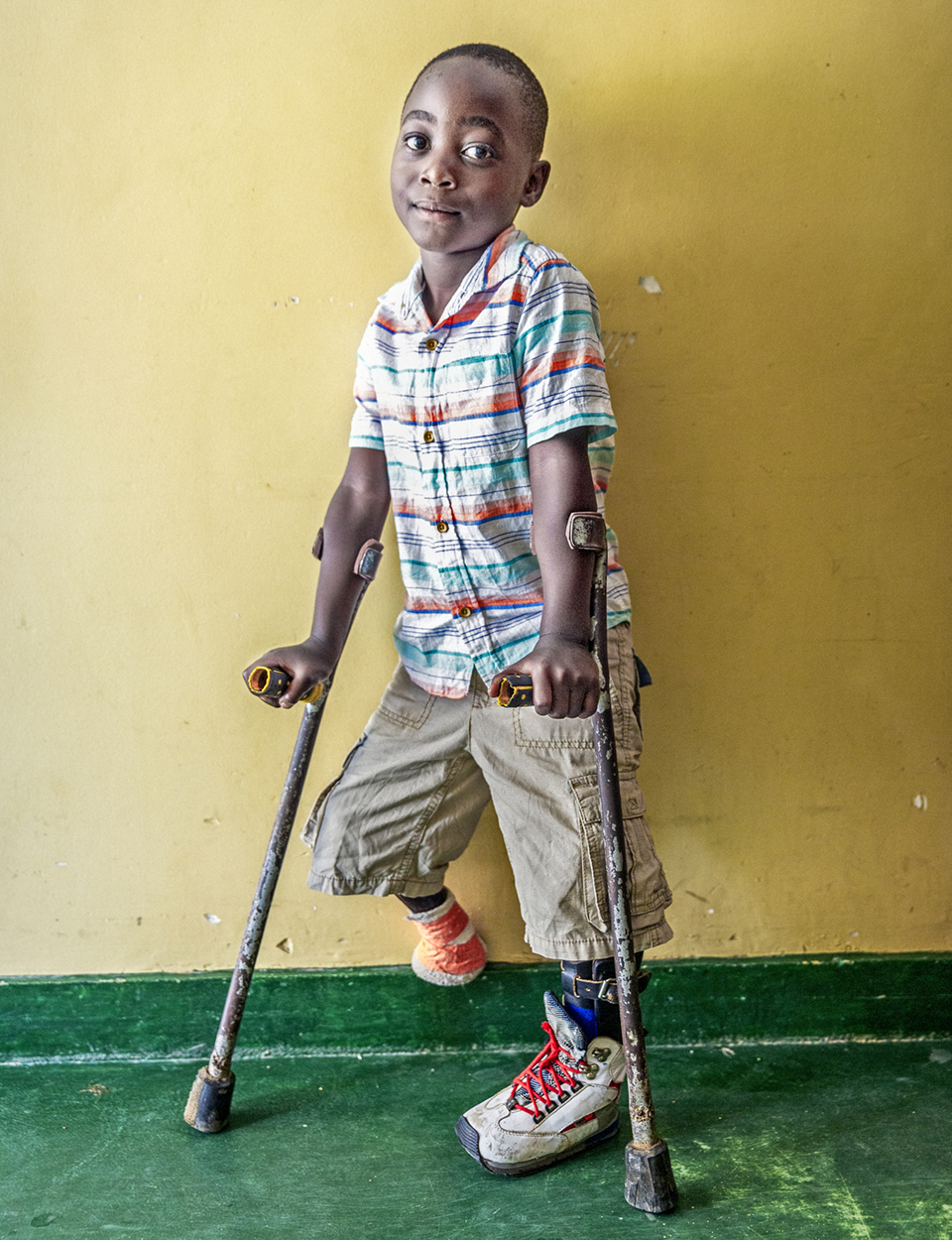 A young boy with a prosthetic leg stands using crutches, wearing a striped shirt, khaki shorts, and trainers, smiling softly against a yellow wall with a green floor.